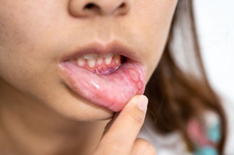 close-up-asian-woman-have-aphthous-ulcer-canker-sore-mouth-lip-1